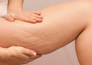 Astuces pour combattre la cellulite